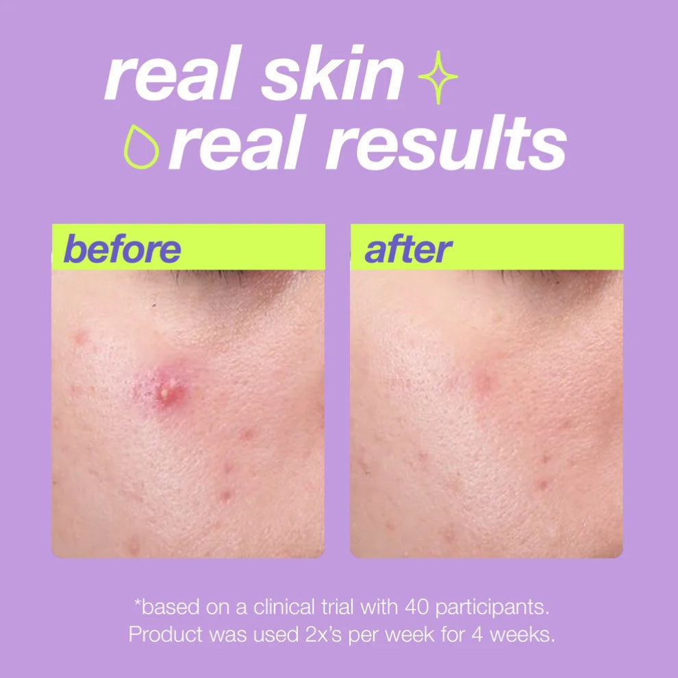 Dermalogica Breakout Clearing Liquid Peel