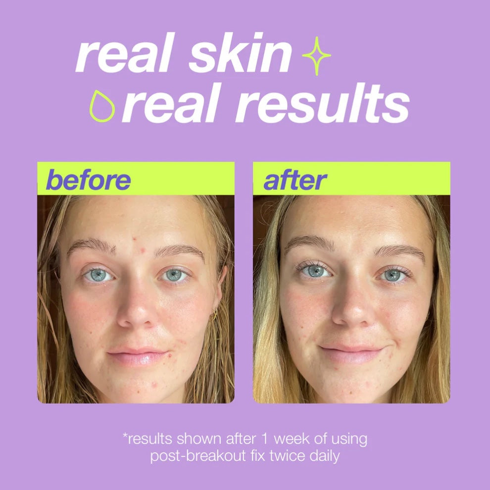 Dermalogica Post-Breakout Fix